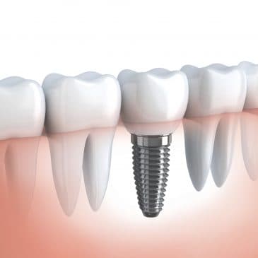All-On-4 Dental Implants Giving Renewed Smiles for Anyone in Need – Rye, NY